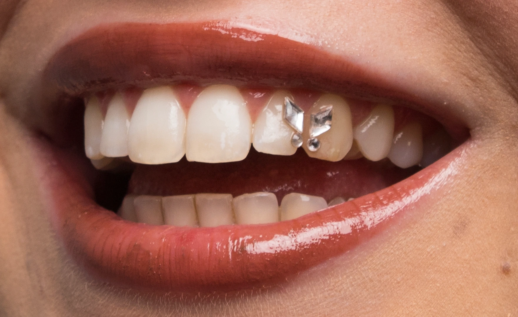 gemas dentales mariposa en valencia