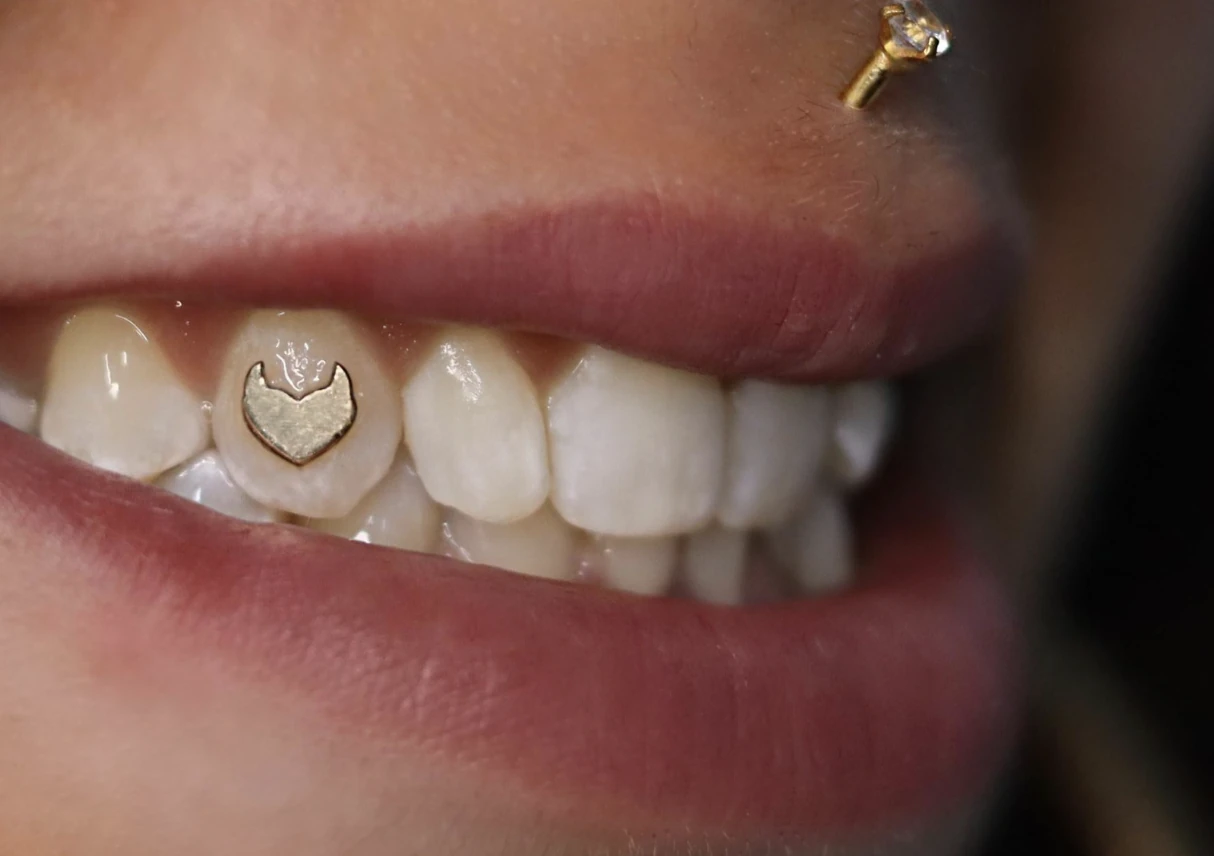 gemas dentales oro en valencia